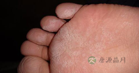 达克宁能根治脚气吗