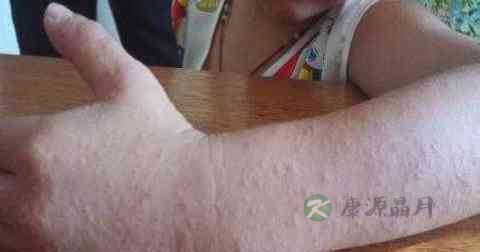 毛囊炎用什么药好