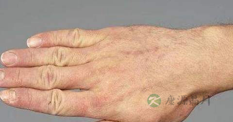 漆疮用什么药擦