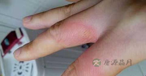 烫伤膏应该怎么用
