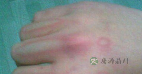 烫伤用什么药
