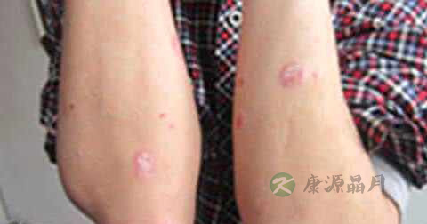 皮癣用什么药好