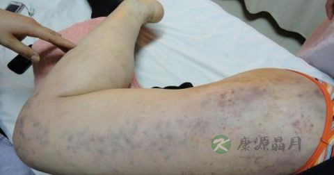 神经性皮炎用什么药膏