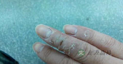 神经性皮炎用什么药膏