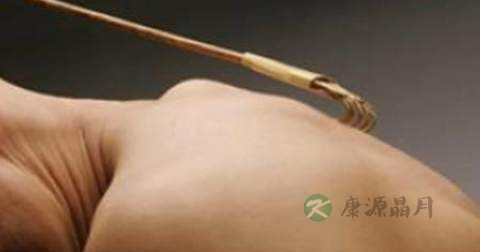 皮炎平杀细菌吗