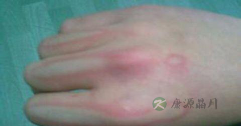 烫伤膏应该怎么用