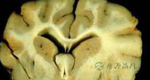 脑白质病吃什么药好