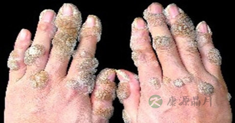扁平疣和瘊子的区别