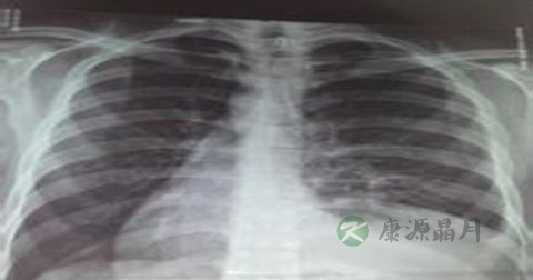 胸膜炎是传染病吗