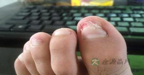 灰指甲前期怎么治疗