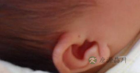 耳轮脚瘘管怎么治