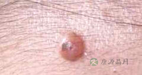 怎样去掉脸上的瘊子