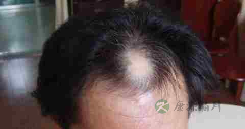 毛囊炎多久洗一次头