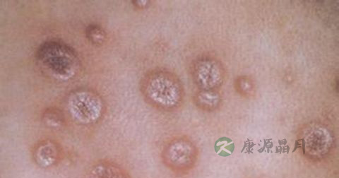 梅毒的症状