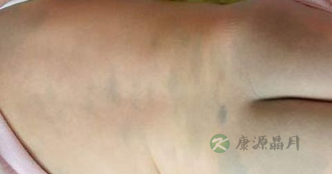 红色胎记怎么治