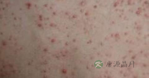 脸上毛囊炎能吃苹果吗