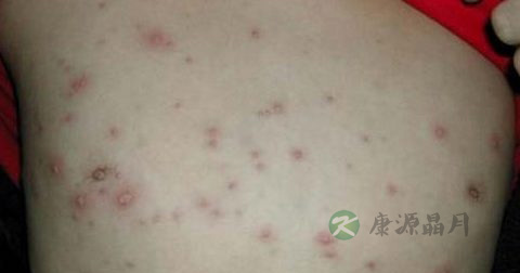 水痘结痂后能吹风吗