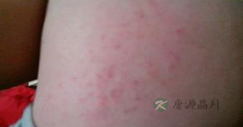 寻马疹是传染病吗
