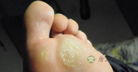 脚上有鸡眼怎么办