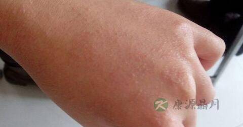 丹毒吃什么水果好