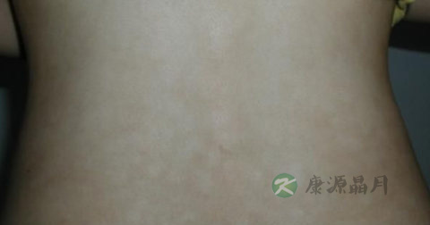 汗斑传染吗