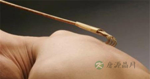神经性皮炎可以吃海鲜吗