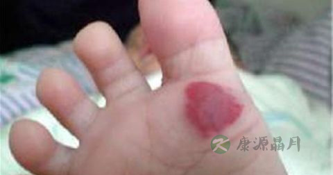 海绵体血管瘤最佳治疗方法