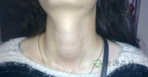 怎么治甲状腺囊肿