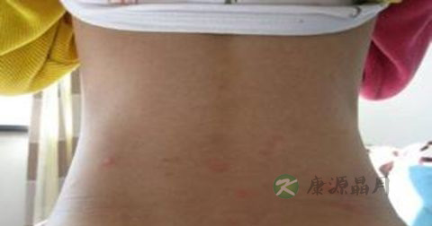 水痘是传染病吗