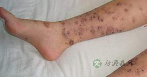 皮肤血管炎可注射止血敏吗