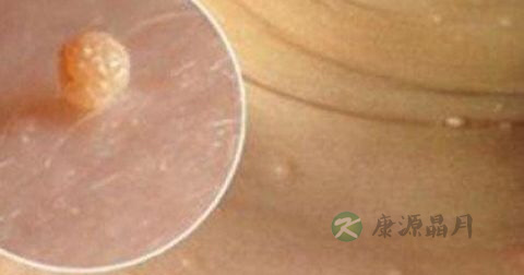 丝状疣怎么治