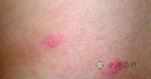 风疹是传染病吗
