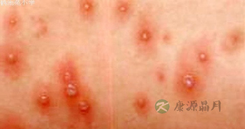 怀孕9个月孕妇出水痘是传染病吗