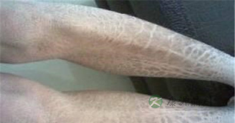 轻微鱼鳞病怎么治