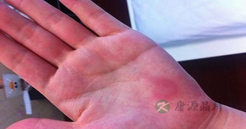 大腿肿是丹毒吗