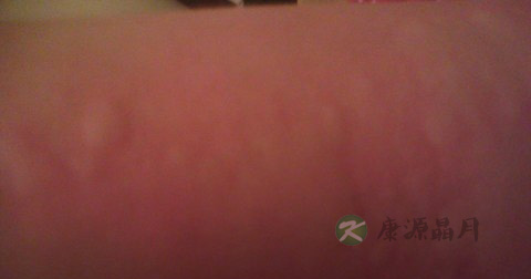 荨麻疹是否会传染