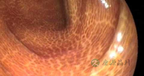 黑变病能治好吗