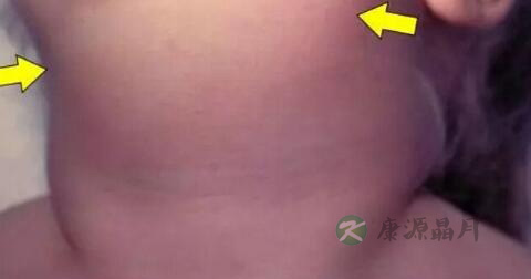 慢性化脓性腮腺炎怎么办