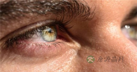 红眼病多久能好