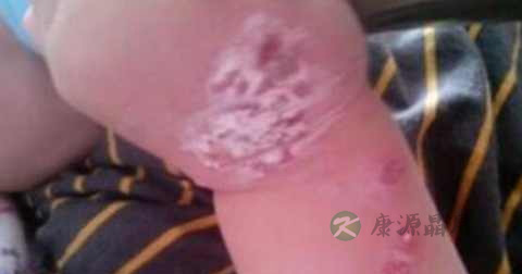 单纯疱疹传染途径