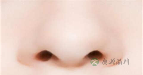 轻微酒糟鼻怎么治