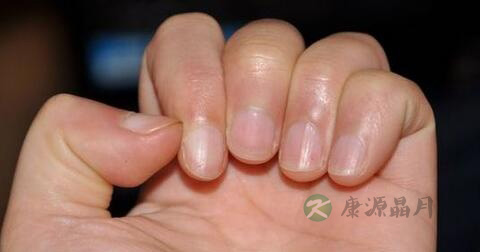 紫癫病的病因和治疗方法