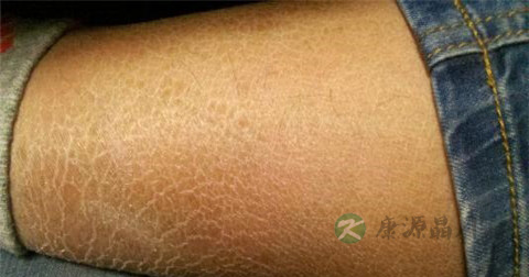 轻微鱼鳞病怎么治