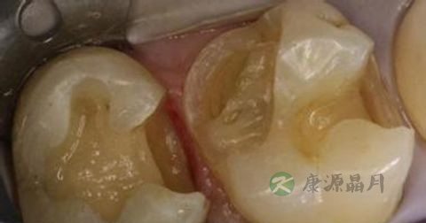 龋齿是传染病吗