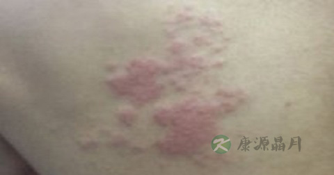 治湿疹好的方法