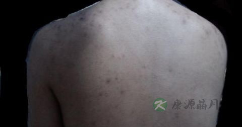 毛囊炎用皮炎平可以吗