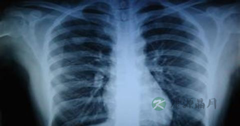 结核病如何预防接种