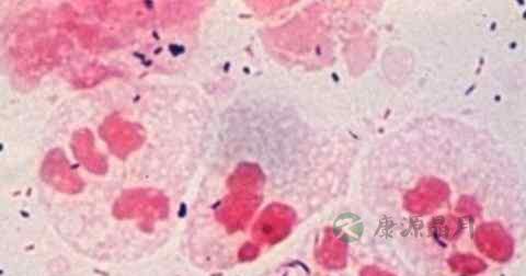 淋病如何预防