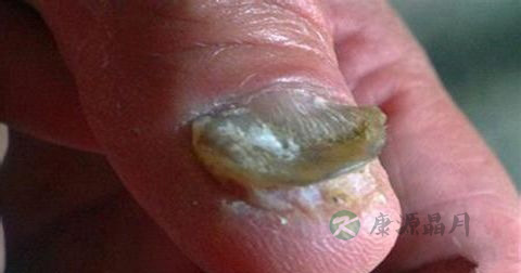 治疗灰指甲的偏方