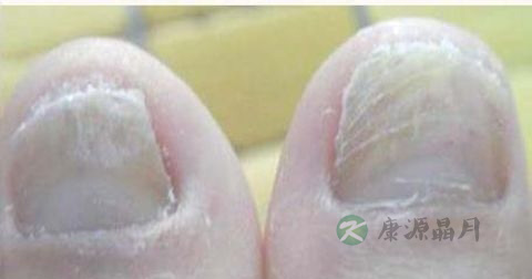治灰指甲的药有哪些